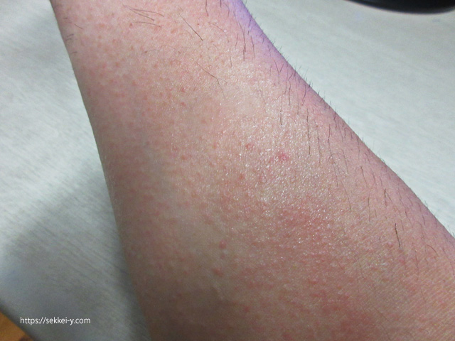 腕の内側の湿疹+痒み